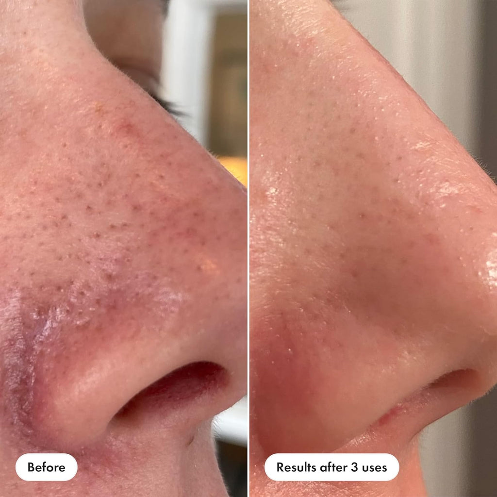 Mighty Patch Nose Patch and Pore Release from Hero Cosmetics